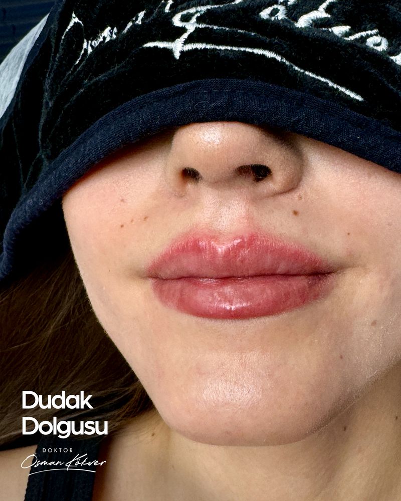 Dudak dolgusu uygulama örneği — doğal hacim ve kontur, Dr. Osman Kökver, Denizli