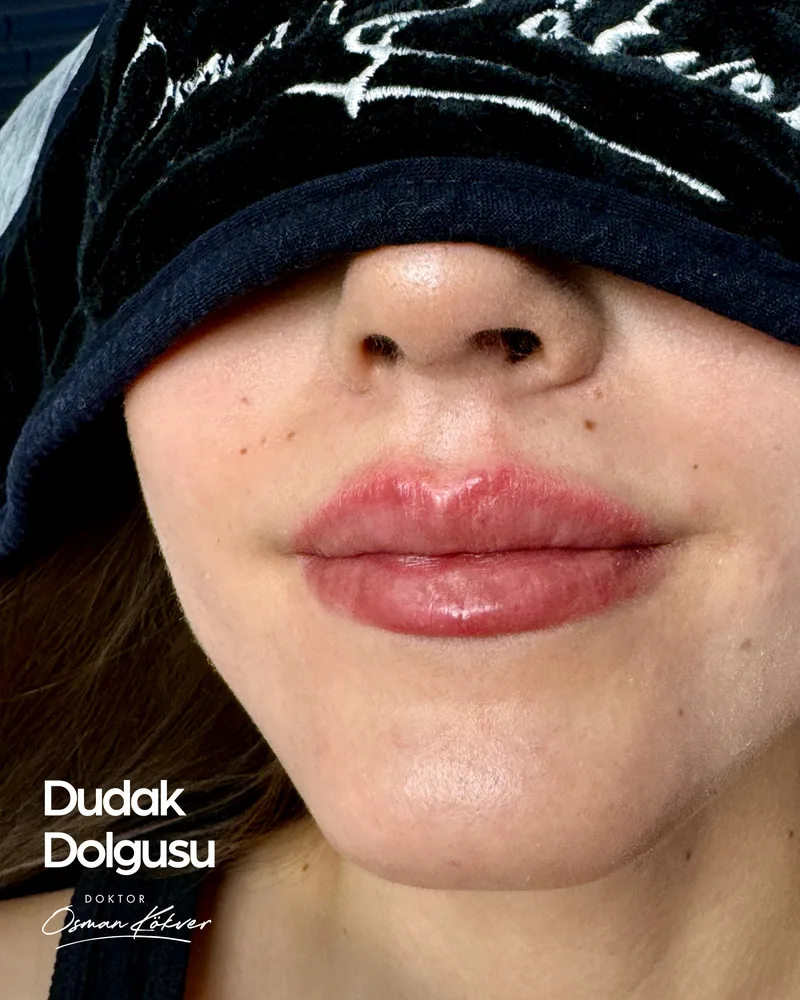 Dudak dolgusu uygulama örneği — ince yapılı dudakta doğal hacim, Dr. Osman Kökver Denizli