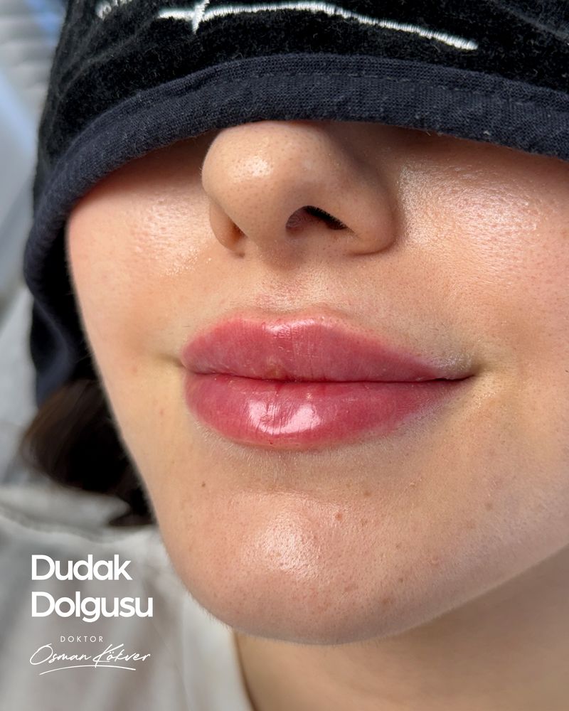 Dudak dolgusu uygulama örneği — mevcut dudak formuna sadık doğal dolgunlaştırma