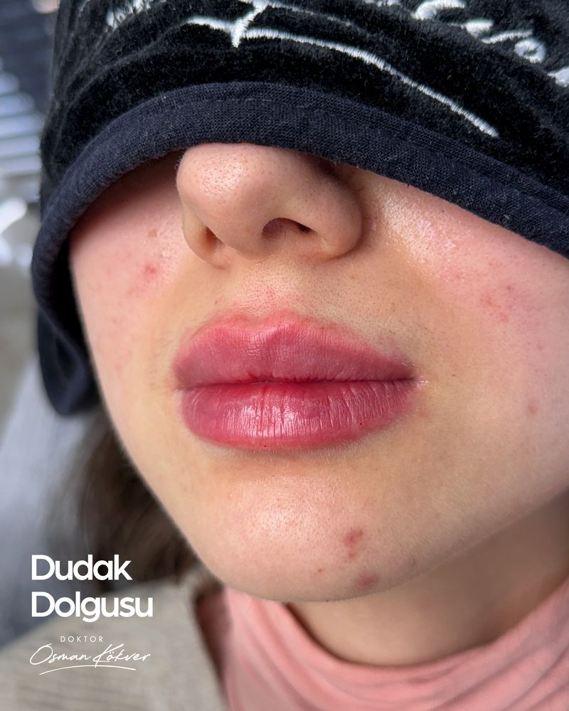 Dudak dolgusu örneği — alt ve üst dudak dengesi gözetilen ölçülü uygulama