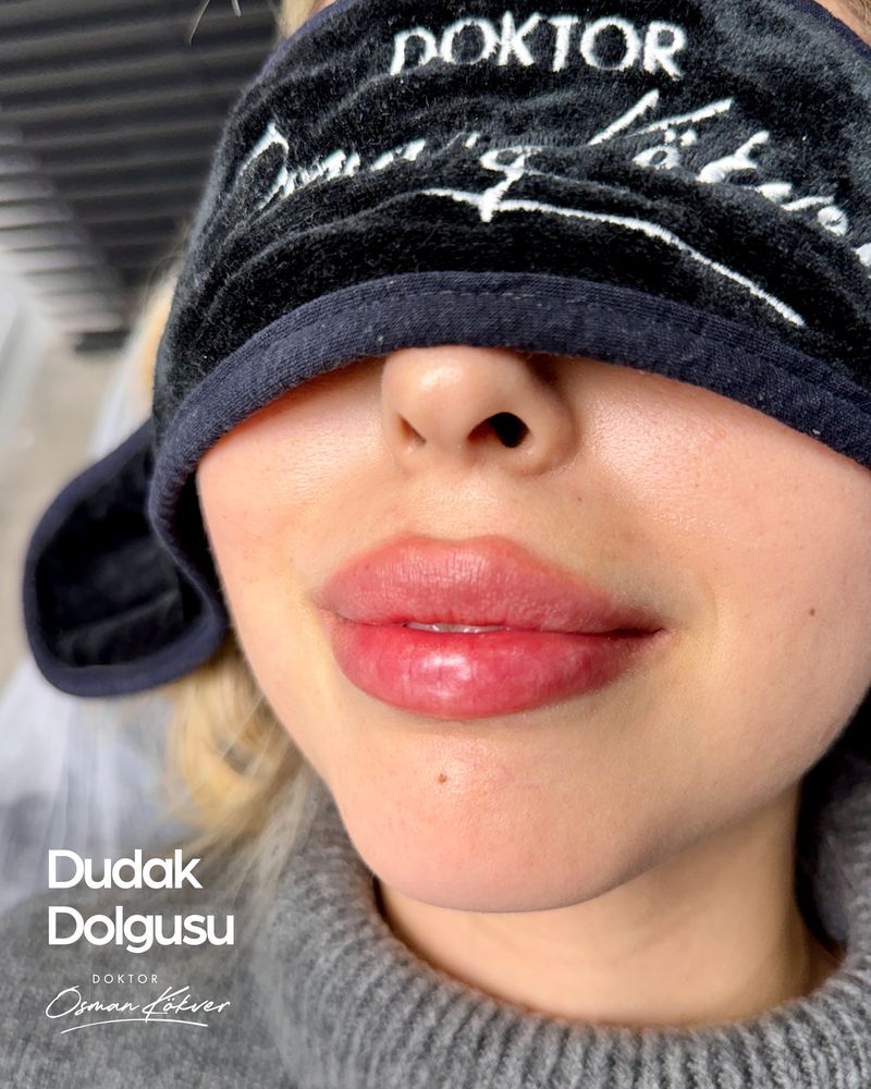 Dudak dolgusu örneği — profilden dengeli duran yumuşak geçişli hacim